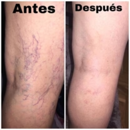 Adiós Venas Spray con envío gratis